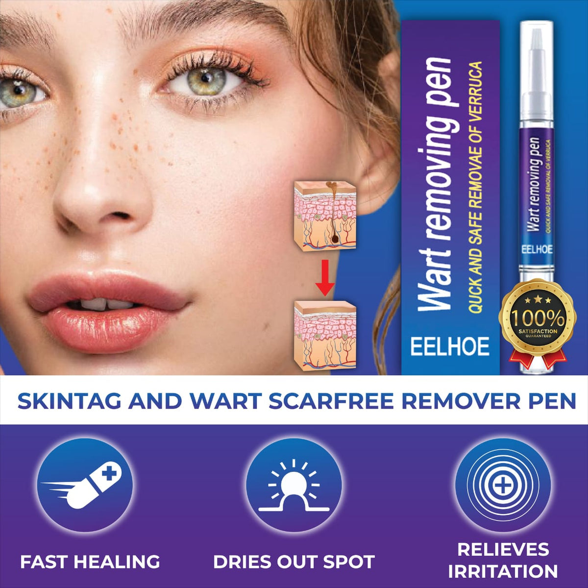 🩹 Wart Remover Gel Pen – Complete Shopify Product Listing