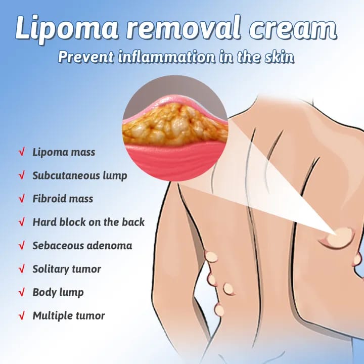 Herbal Lipoma Care Cream 50g | Targeted Fatty Lump Skin Care Cream
